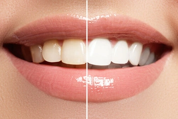 Instant Teeth Whitening results