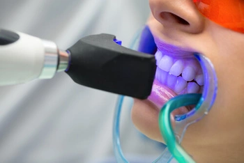 what to eat after laser teeth whitening plan