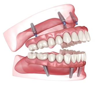 Cost For Full Mouth Dental Implants image
