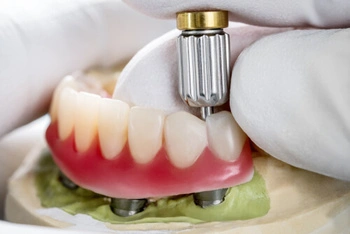 implant dentures tried on