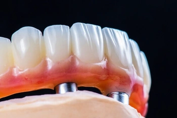 implant supported denture illustration