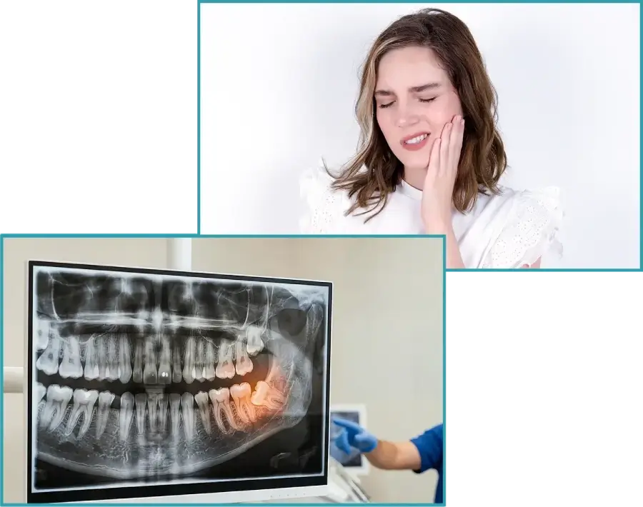 Why Choose Wisdom Teeth Removal at Our Clinic