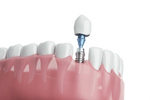 photo showing regeneration of jawbone volume, with a dental implant placed in the improved site
