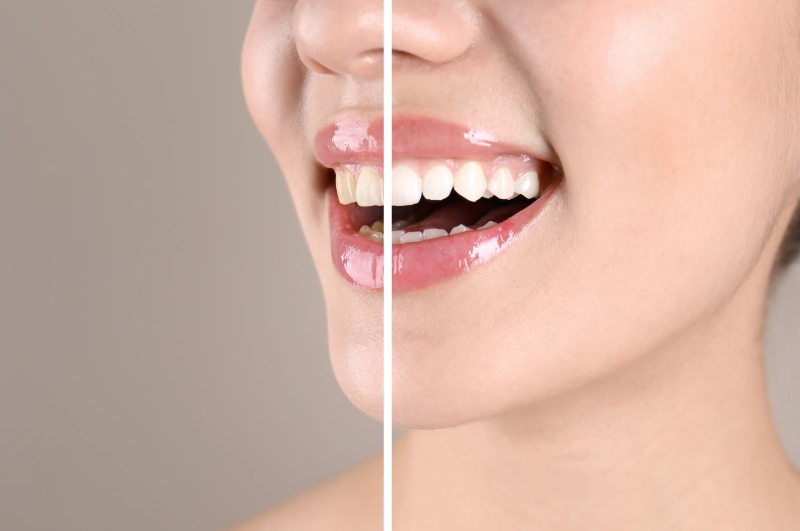 teeth whitening before and after comparison
